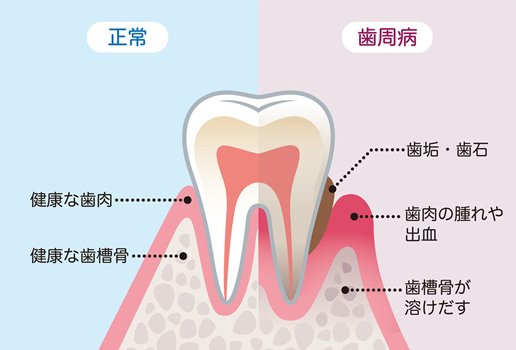 正常/歯周病